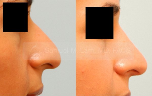 Middle Eastern Rhinoplasty Result Dallas