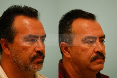 Nose result after Injectable Rhinoplasty, Dallas TX