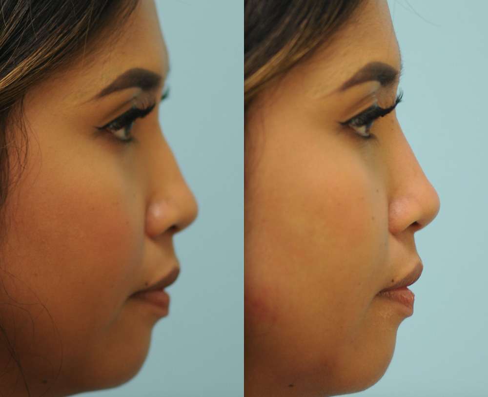 nose with bump and the nose after Injectable Rhinoplasty, Dallas TX