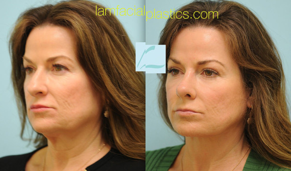 Caucasian Rhinoplasty Result Dallas