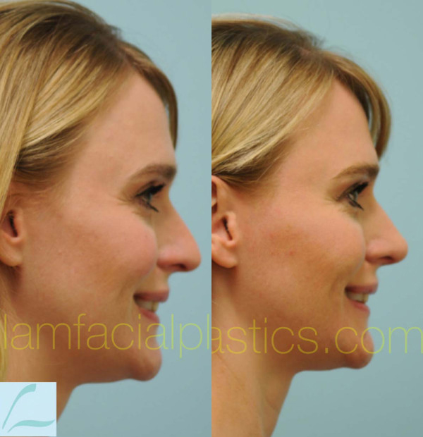 Caucasian Rhinoplasty Result Dallas