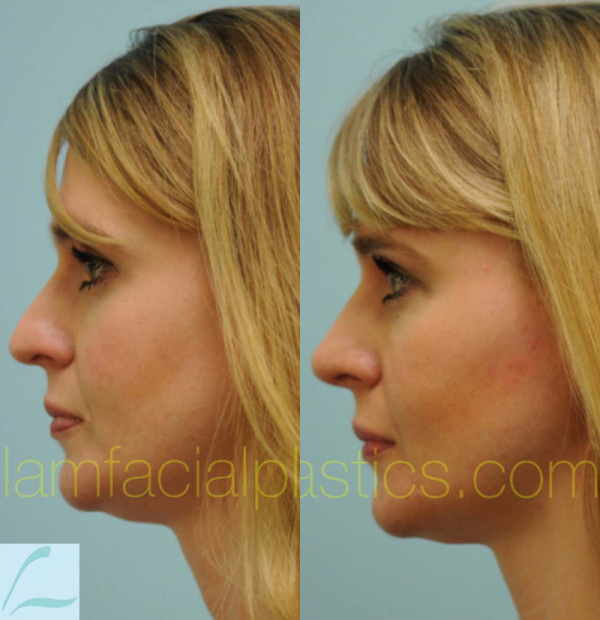 Caucasian Rhinoplasty Result Dallas