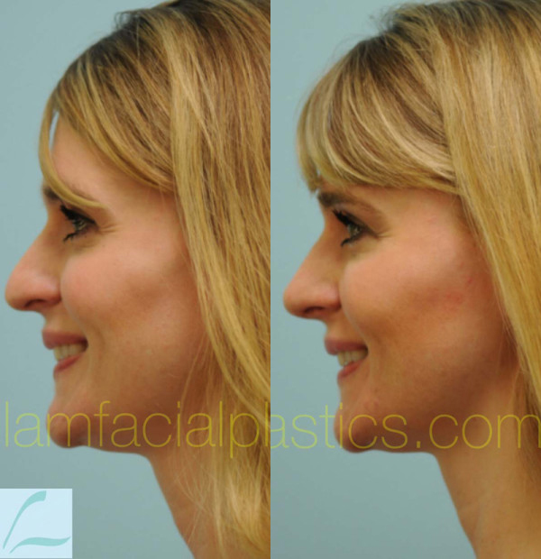 Caucasian Rhinoplasty Result Dallas