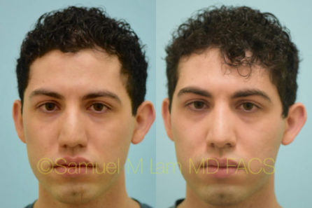 Rhinoplasty Result Dallas