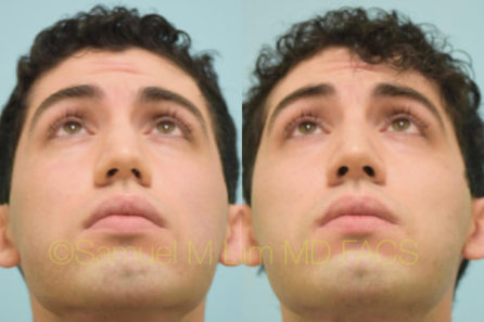 Rhinoplasty Result Dallas