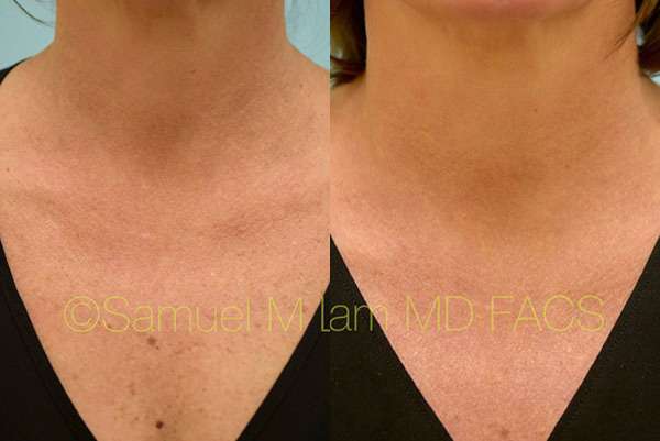 Dallas Botox Before and After Photos - Plano Plastic Surgery Photo Gallery  - Dr. Sam LamBotox Archives