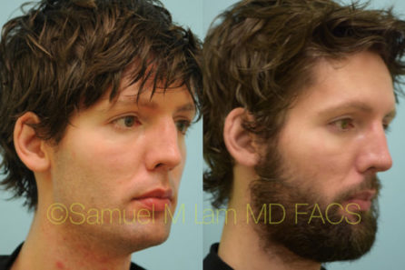 Caucasian Rhinoplasty Result Dallas