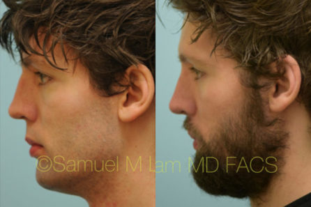 Caucasian Rhinoplasty Result Dallas