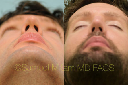 Caucasian Rhinoplasty Result Dallas