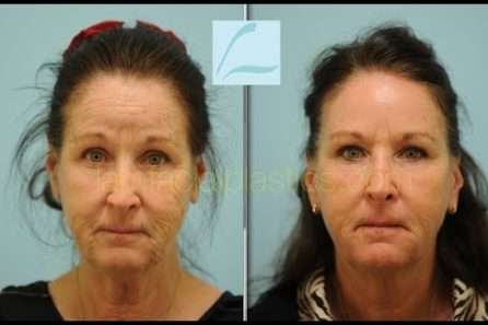 Sciton Contour TRL Laser Resurfacing Testimonial in Dallas, Texas