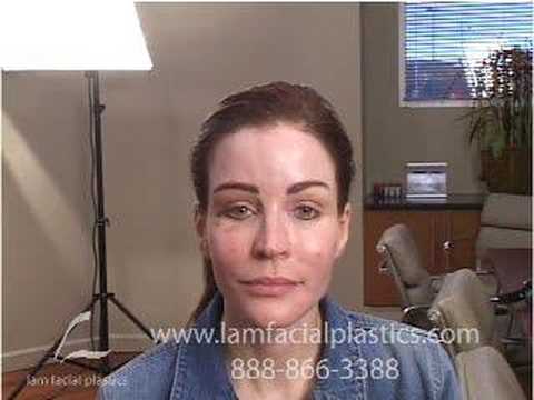 DALLAS PLASTIC SURGERY BROW LIFT CORRECTION W/FAT GRAFTING