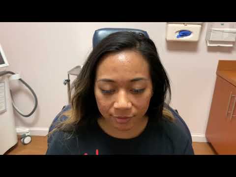 Dallas Botox for Cystic Acne Correction