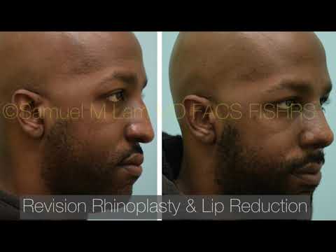 Dallas Revision Rhinoplasty and Lip Reduction Testimonial with Before and After