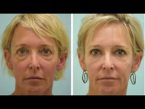 Dallas Upper and Lower Blepharoplasty, and Fat Transfer Testimonial with Photos