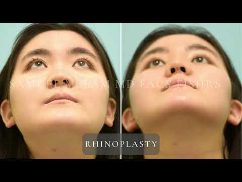Dallas Cosmetic Surgery | Rhinoplasty | Patient Testimonial