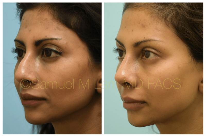 Rhinoplasty