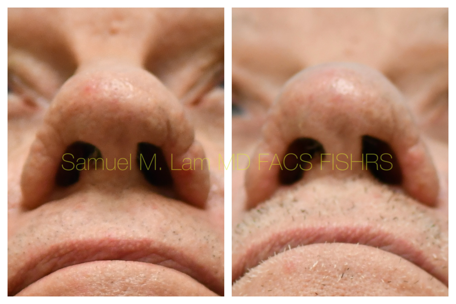 Rhinopyma Before and After Photo by Dr. Lam in Plano, TX