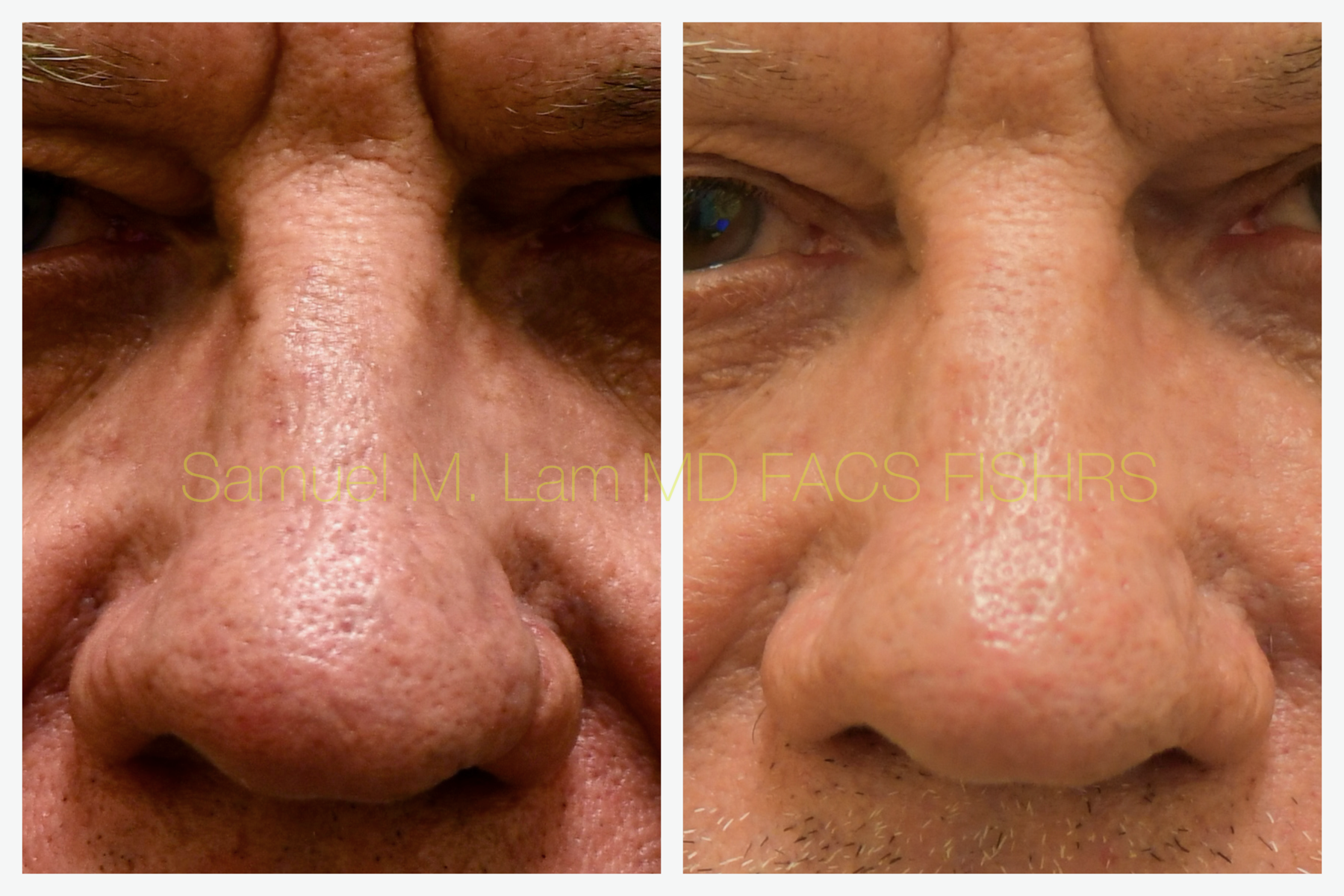 Rhinopyma Before and After Photo by Dr. Lam in Plano, TX