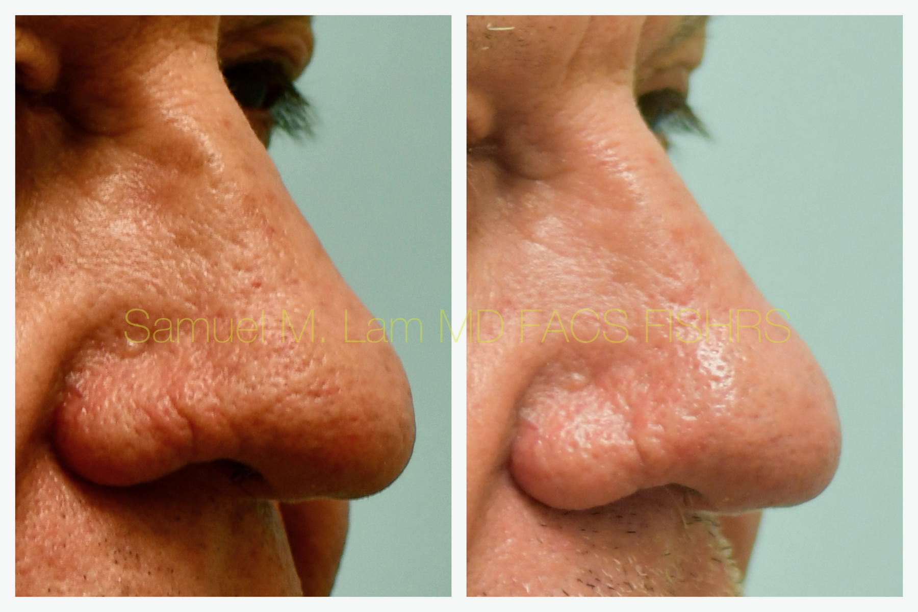 Rhinopyma Before and After Photo by Dr. Lam in Plano, TX