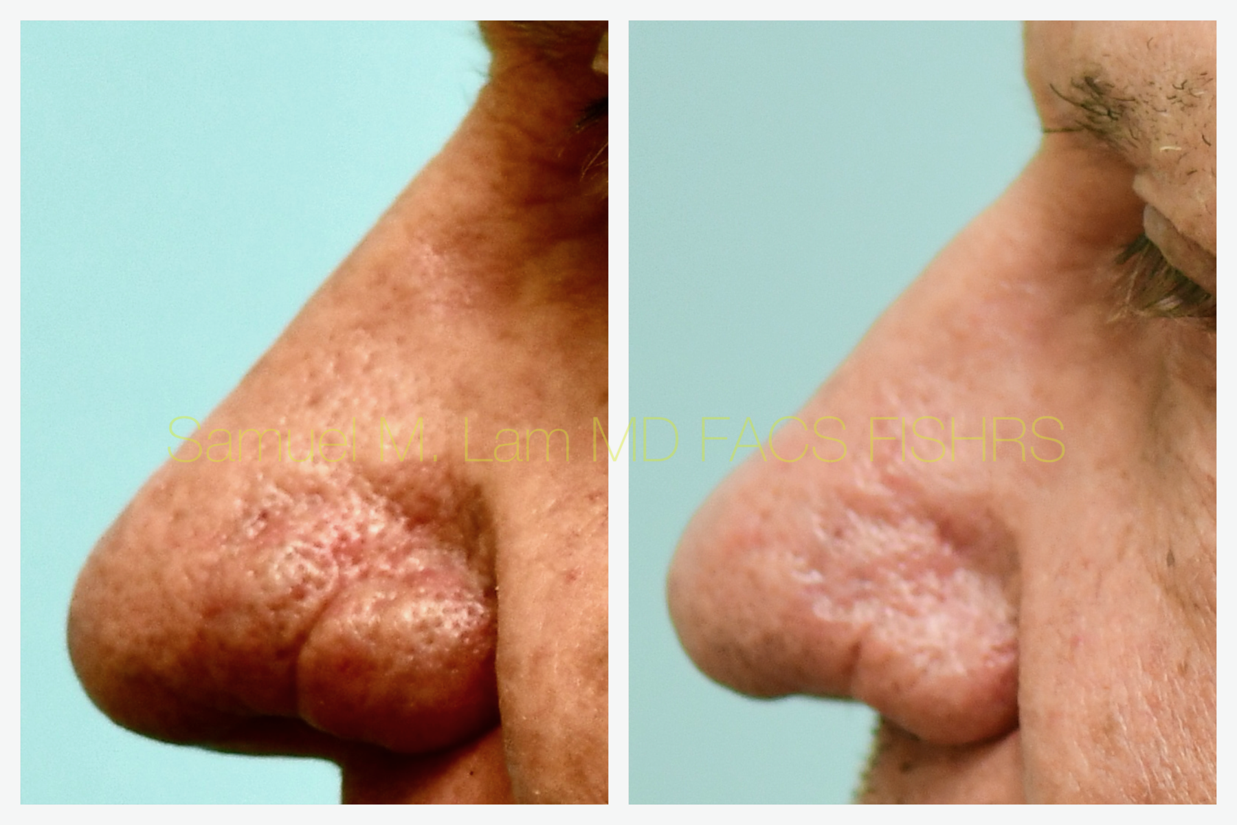 Rhinopyma Before and After Photo by Dr. Lam in Plano, TX