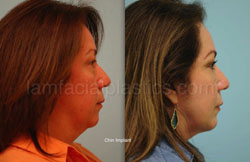 Chin Augmentation Before & After