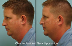 Chin Augmentation Before & After