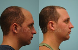 Chin Augmentation Before & After