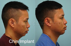 Chin Augmentation Before & After