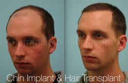 Chin Augmentation Before & After