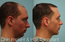 Chin Augmentation Before & After