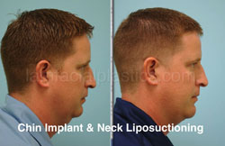 Chin Augmentation Before & After