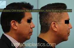 Chin Augmentation Before & After