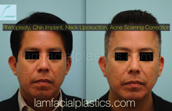 Chin Augmentation Before & After