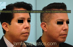 Chin Augmentation Before & After