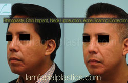 Chin Augmentation Before & After