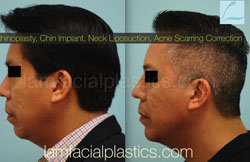 Chin Augmentation Before & After