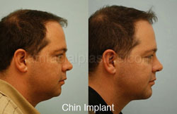 Chin Augmentation Before & After