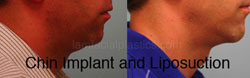 Chin Augmentation Before & After