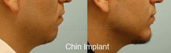 Chin Augmentation Before & After