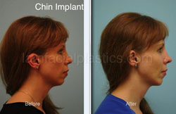 Chin Augmentation Before & After