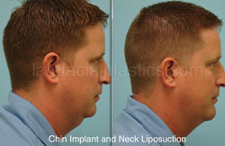 Chin Augmentation Before & After