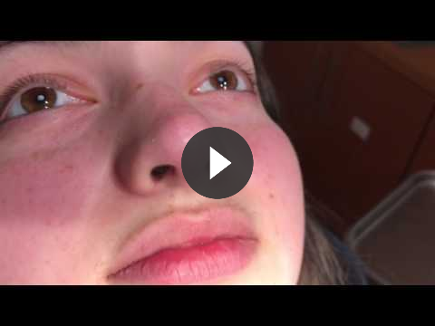 Rhinoplasty Close-Up Incision Video