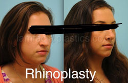 Rhinoplasty Results Dallas
