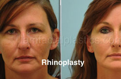 Rhinoplasty Results Dallas