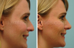 Rhinoplasty Results Dallas