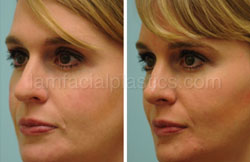 Rhinoplasty Results Dallas