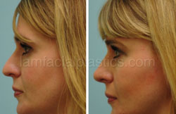 Rhinoplasty Results Dallas