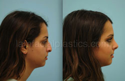 Rhinoplasty Results Dallas