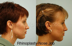 Rhinoplasty Results Dallas