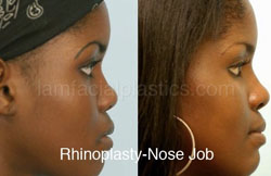 Rhinoplasty Results Dallas